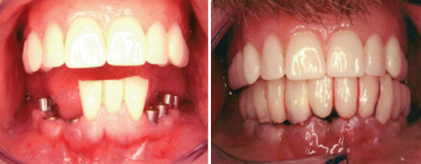 Three natural teeth replaced by fixed twelve unit implant supported bridge