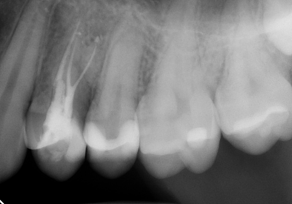 Uncharacteristic bifurcated roots (middle root appearring like forked tongue) are filled with precision with warm root canal filling technique.