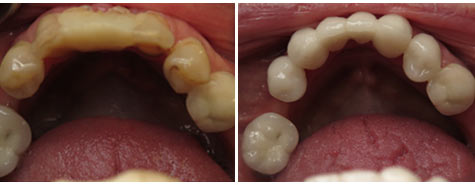 Seven decayed and damaged teeth restored with e.max metal free crowns and bridgework
