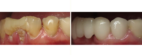 Seven decayed and damaged teeth restored with e.max metal free crowns and bridgework