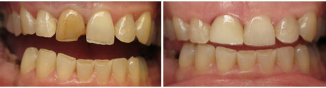 Right front tooth restored with e.max all porcelain crown