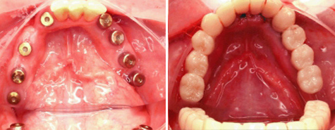 Three natural teeth replaced by fixed twelve unit implant supported bridge