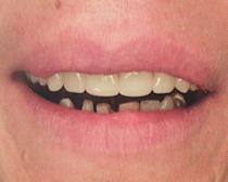 Teeth 2
