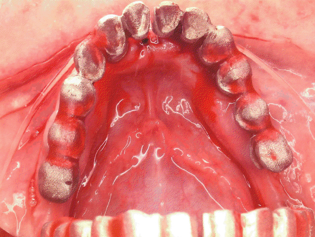 3 hopeless teeth were extracted and abutments are placed atop implant fixtures
