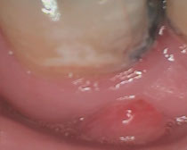 Oral Cancer 3
